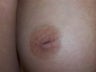 Inverted Nipple Repair