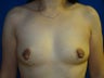 Nipple Reduction and Breast Augmentation