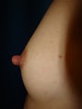 Nipple Reduction Surgery