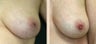 Inverted Nipple Repair