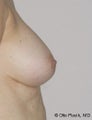 Nipple Reduction