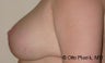Nipple Reduction