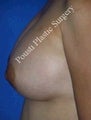 Nipple Surgery