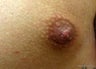 Nipple reduction