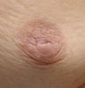 Correction of Underprojected Nipple