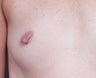 Nipple Reduction