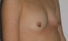 Nipple Reduction
