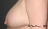Nipple Reduction