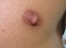 Nipple reduction