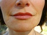 Non Surgical Face Lift