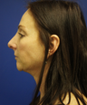 Non-Surgical Face Lift