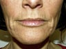 Non Surgical Face Lift
