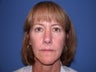 Before and After Nonsurgical Facelift