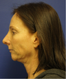 Non-Surgical Face Lift