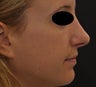 Non Surgical Nose Job