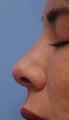 Non-Surgical Rhinoplasty