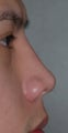 Non-Surgical Rhinoplasty