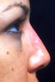 Non Surgical Nose Job