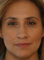 Non Surgical Nose Job