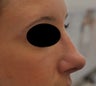 Non Surgical Nose Job