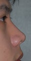 Non-Surgical Rhinoplasty