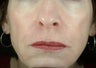Liquid Facelift (Injectables)