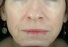 Liquid Facelift (Injectables)