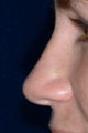 Non Surgical Nose Job