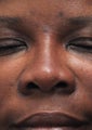 Non Surgical Rhinoplasty