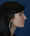 Non Surgical Rhinoplasty