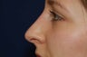 Non-Surgical Rhinoplasty