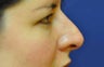 Non Surgical Nose Job