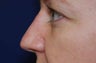 Non-Surgical Rhinoplasty