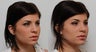 Non Surgical Nose Job Rhinoplasty