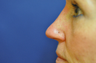 Non Surgical Nose Job