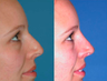 Non-surgical Nose Job - Non-surgical rhinoplasty