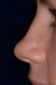 Non Surgical Nose Job