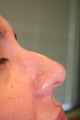 Non-surgical Rhinoplasty