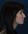 Non Surgical Rhinoplasty
