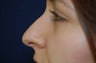 Non-Surgical Rhinoplasty