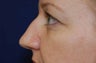 Non-Surgical Rhinoplasty