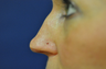 Non Surgical Nose Job