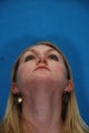 Rhinoplasty (nose job, nasal surgery)