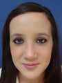 Rhinoplasty