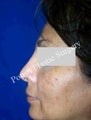 Nose Surgery (Rhinoplasty)