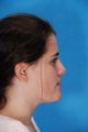 Nose Surgery