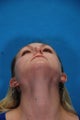 Rhinoplasty (nose job, nasal surgery)