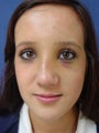 Rhinoplasty