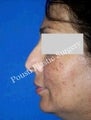 Nose Surgery (Rhinoplasty)