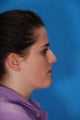 Nose Surgery